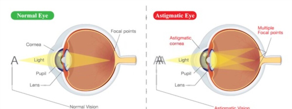 astigmatism